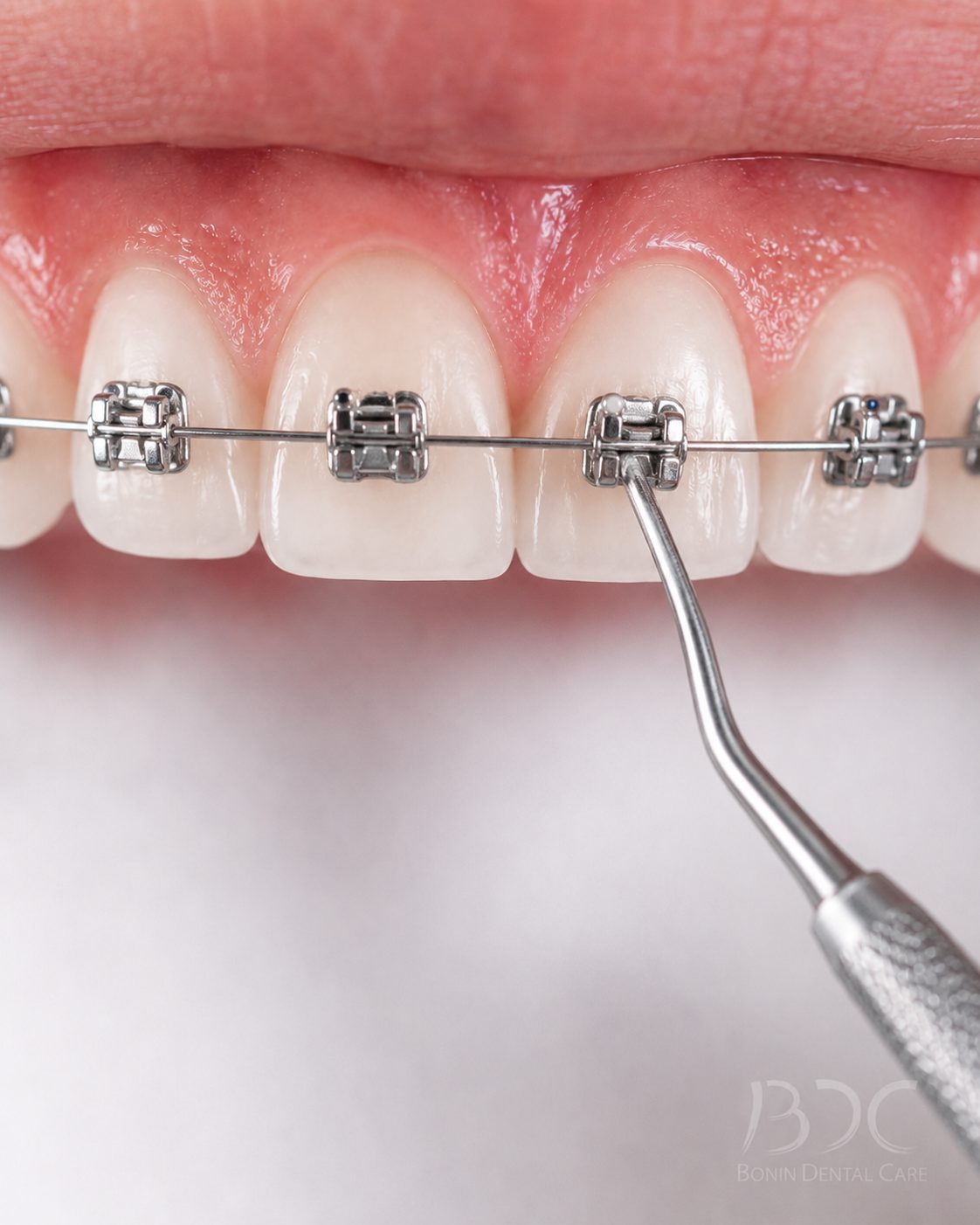 Orthodontic Care (Invisalign In-Office, Braces with Trusted Orthodontists) at Bonin Dental Care