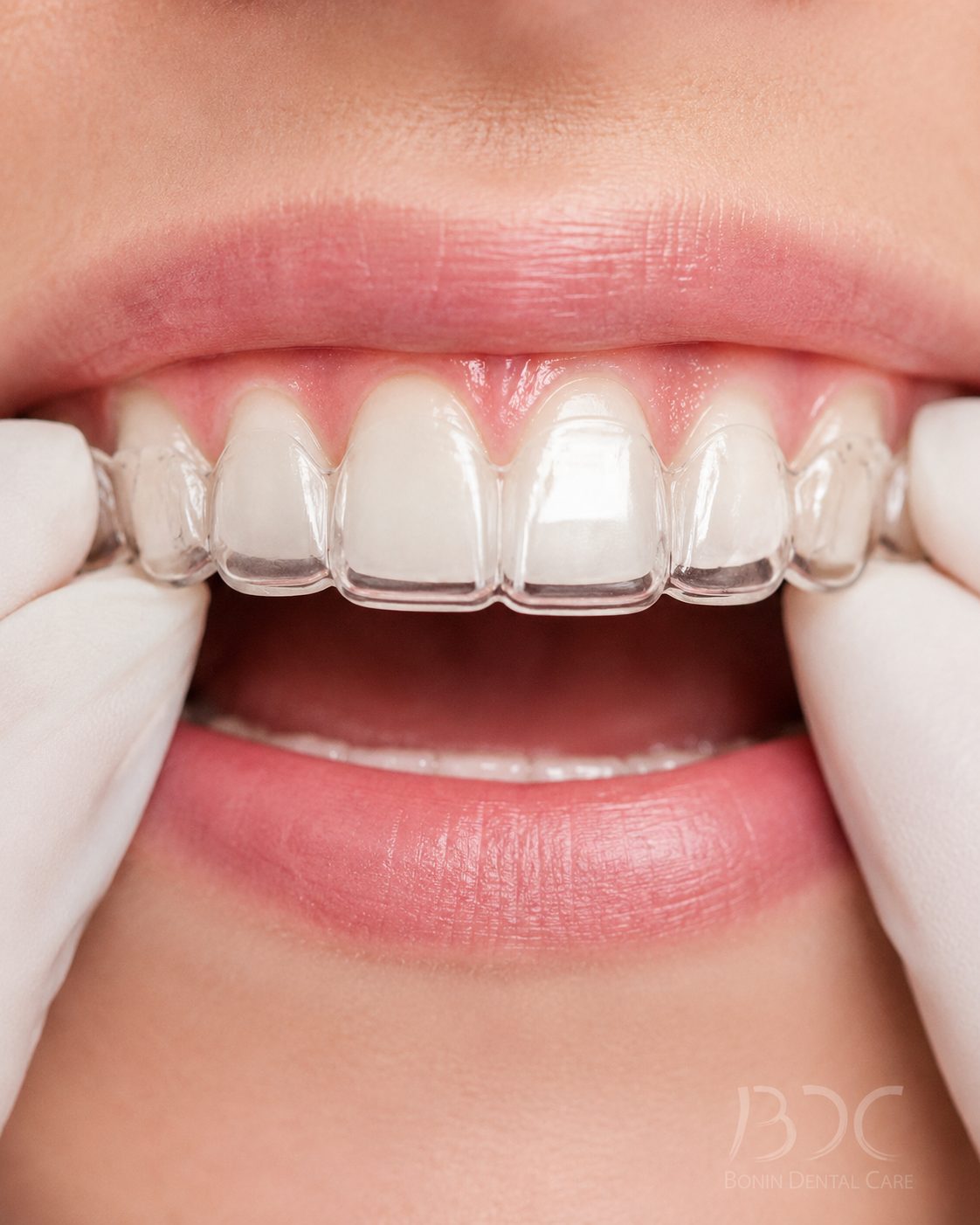 Custom Mouthguards at Bonin Dental Care