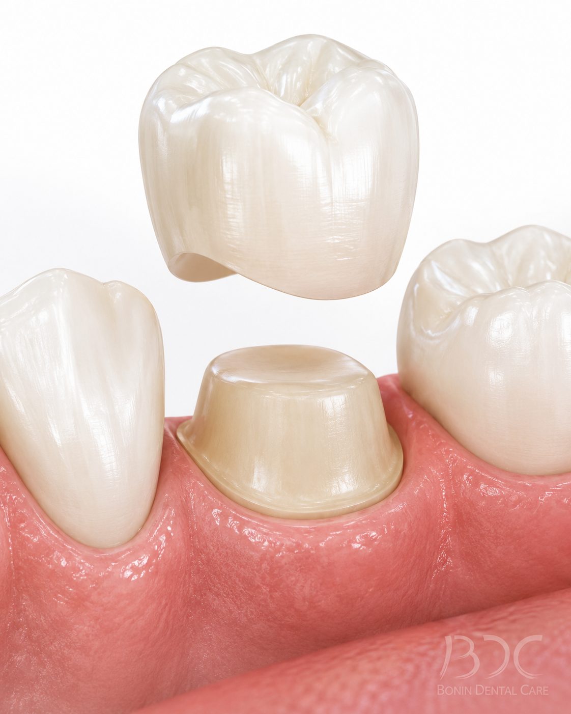 Dental Crowns at Bonin Dental Care