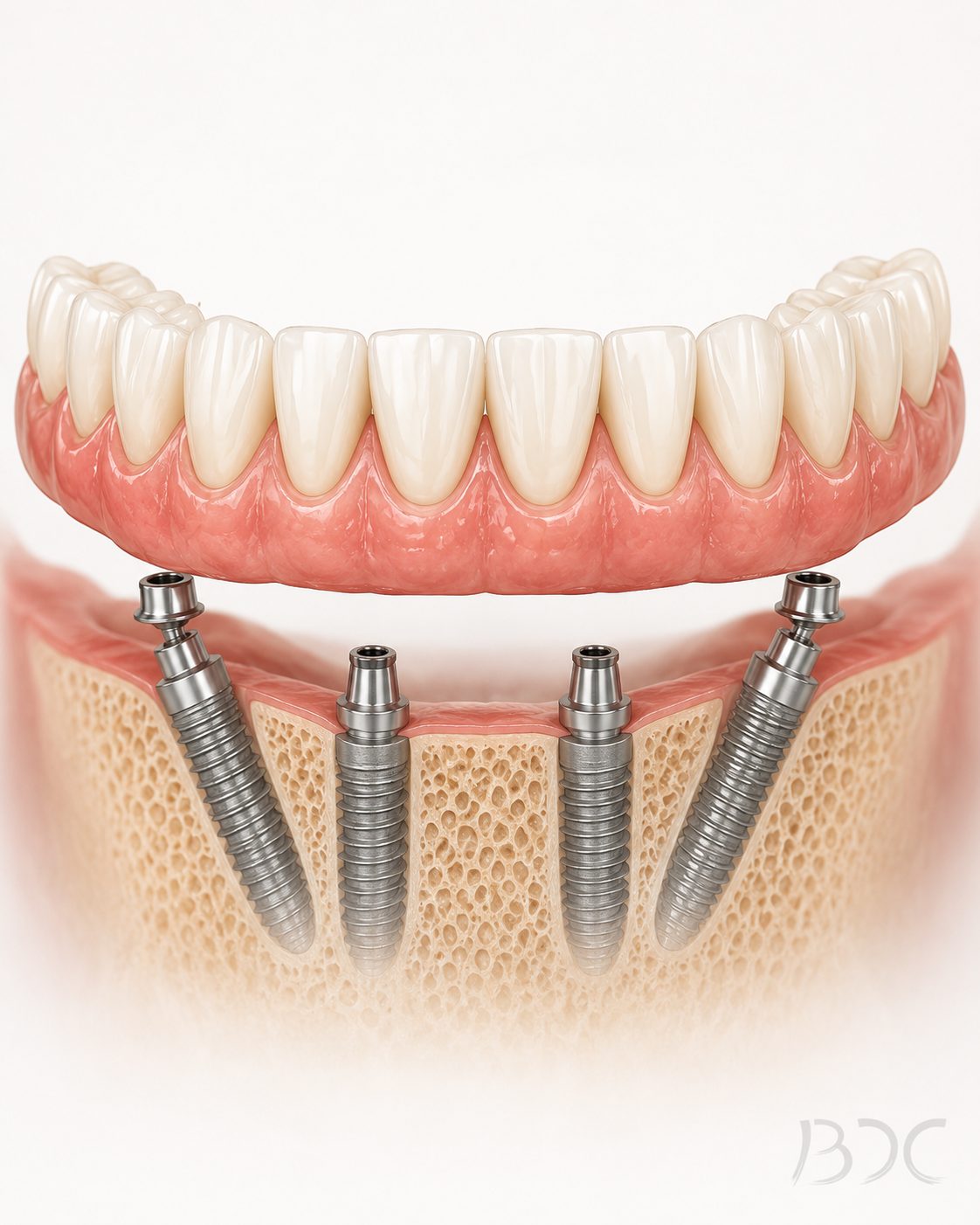 Full-Arch Dental Implants (All-on-4 / All-on-X, Coordinated with Specialists) at Bonin Dental Care