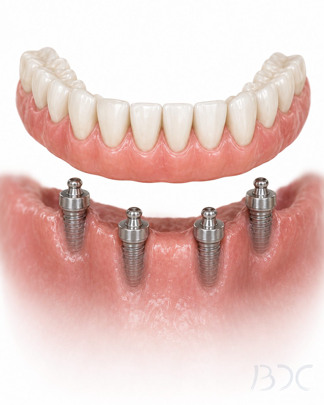 Implant-Supported Dentures (Coordinated with Surgical Specialists) at Bonin Dental Care