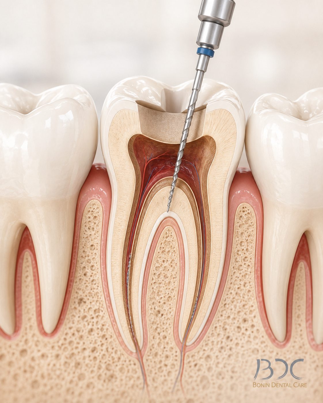 Root Canal Care (Coordinated with Trusted Endodontists) at Bonin Dental Care