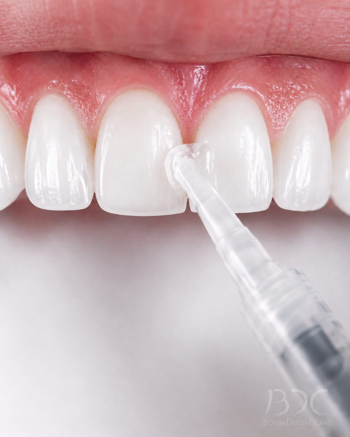 Teeth Whitening (Zoom In-Office & Take-Home) at Bonin Dental Care