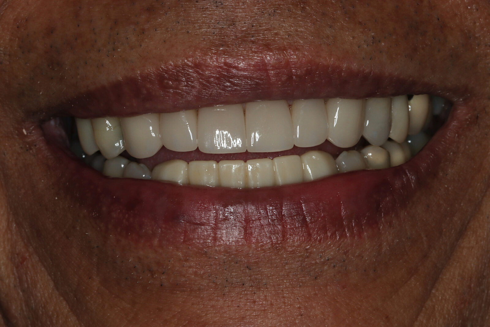 After cosmetic treatment: an even, natural-looking restored upper smile on the same Bonin Dental Care patient