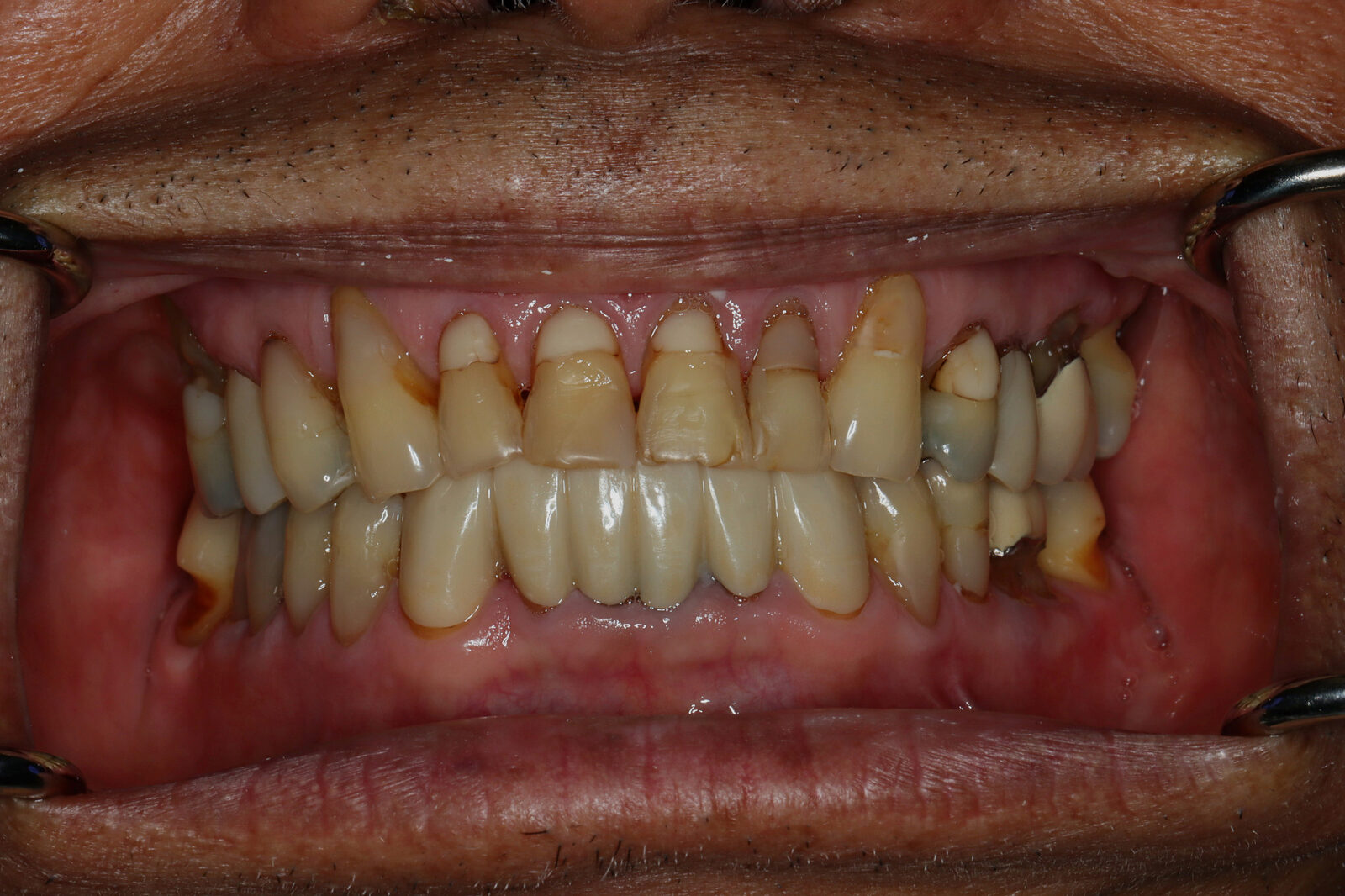 Before cosmetic treatment: worn, crowded, and discolored upper teeth on an actual Bonin Dental Care patient